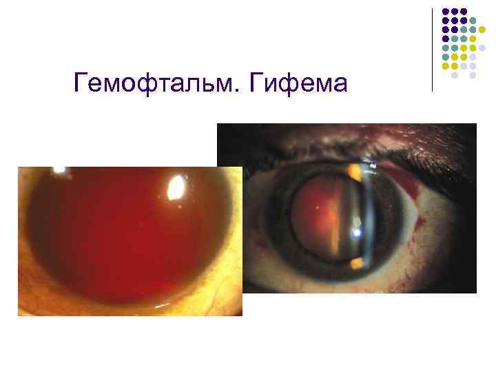 Гемофтальм. Гифема 