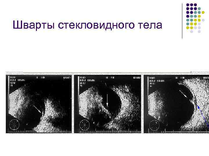 Шварты стекловидного тела 