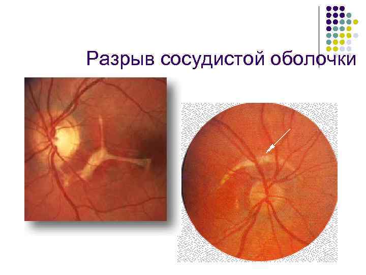 Разрыв сосудистой оболочки 