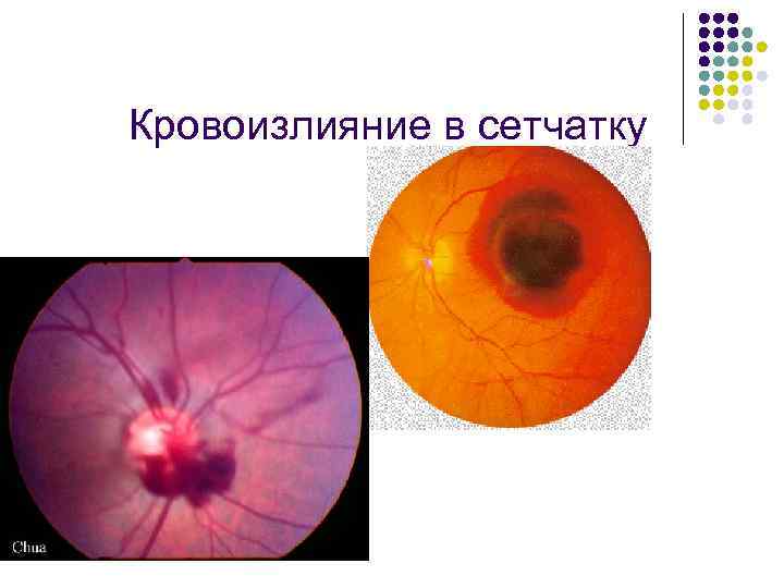 Кровоизлияние в сетчатку 
