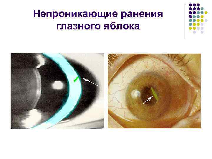 Непроникающие ранения глазного яблока 