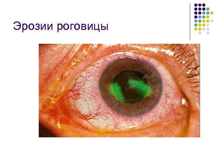Эрозии роговицы 
