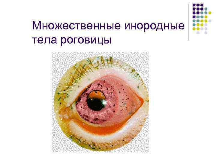 Множественные инородные тела роговицы 