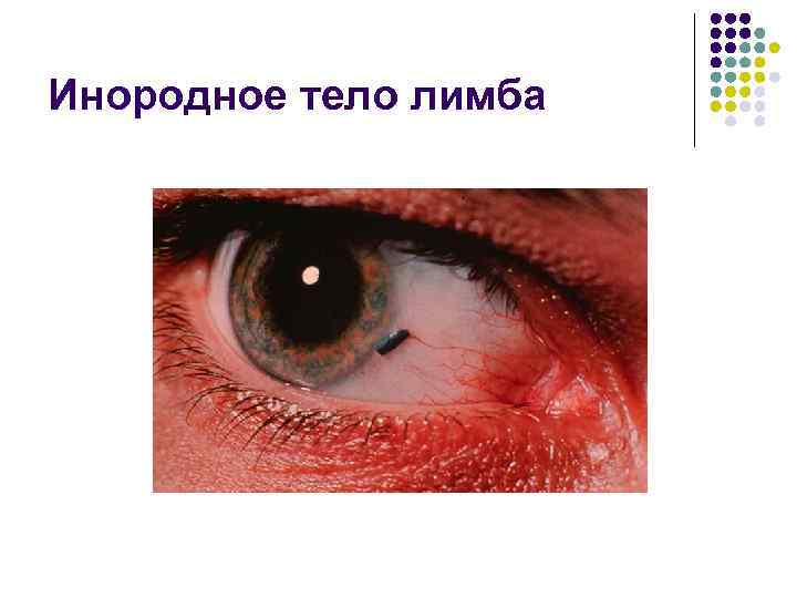 Инородное тело лимба 