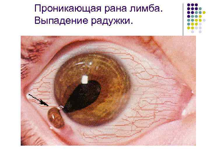 Проникающая рана лимба. Выпадение радужки. 