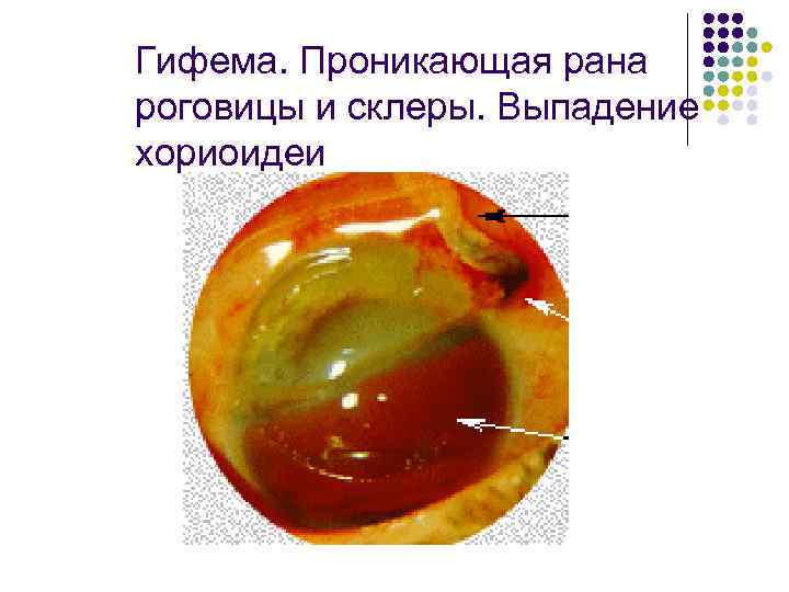 Гифема. Проникающая рана роговицы и склеры. Выпадение хориоидеи 
