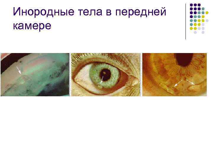 Инородные тела в передней камере 