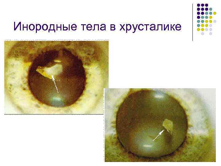 Инородные тела в хрусталике 
