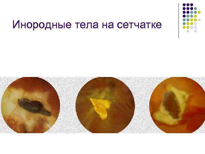 Инородные тела на сетчатке 