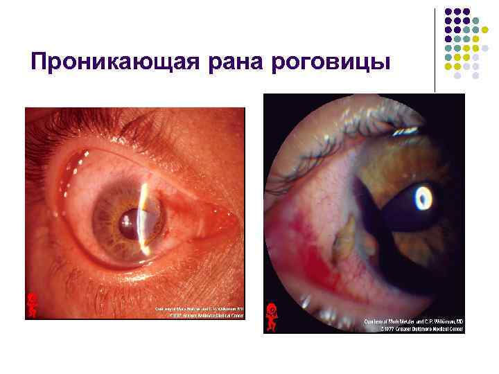 Проникающая рана роговицы 