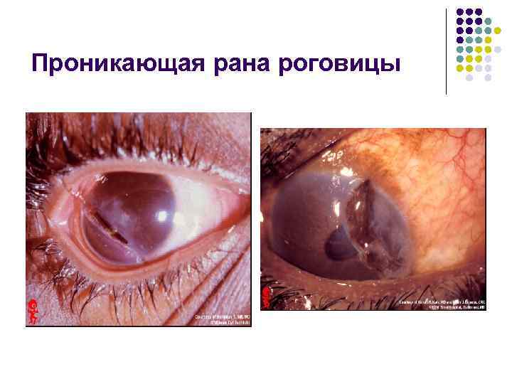 Проникающая рана роговицы 