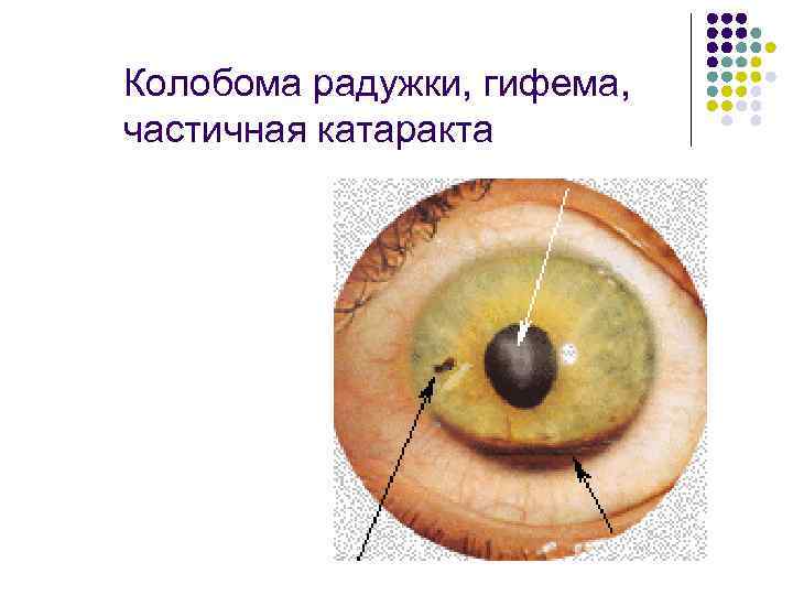 Колобома радужки, гифема, частичная катаракта 