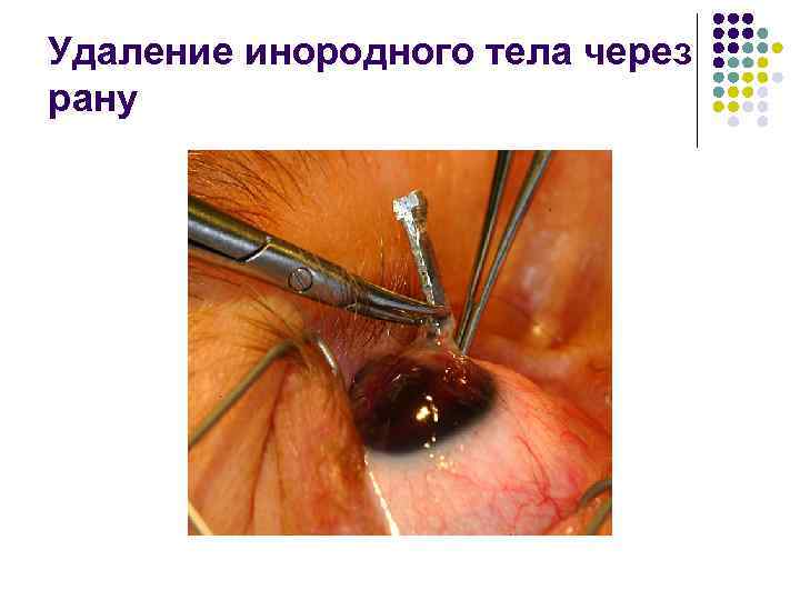 Удаление инородного тела через рану 