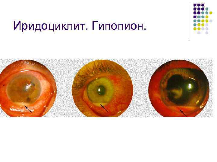 Иридоциклит. Гипопион. 