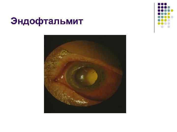 Эндофтальмит 