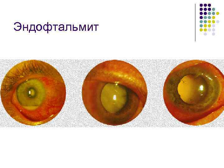 Эндофтальмит 