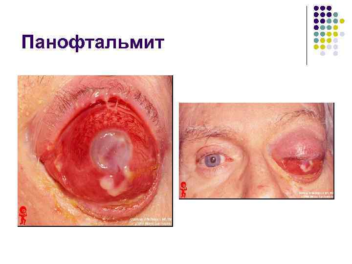 Панофтальмит 