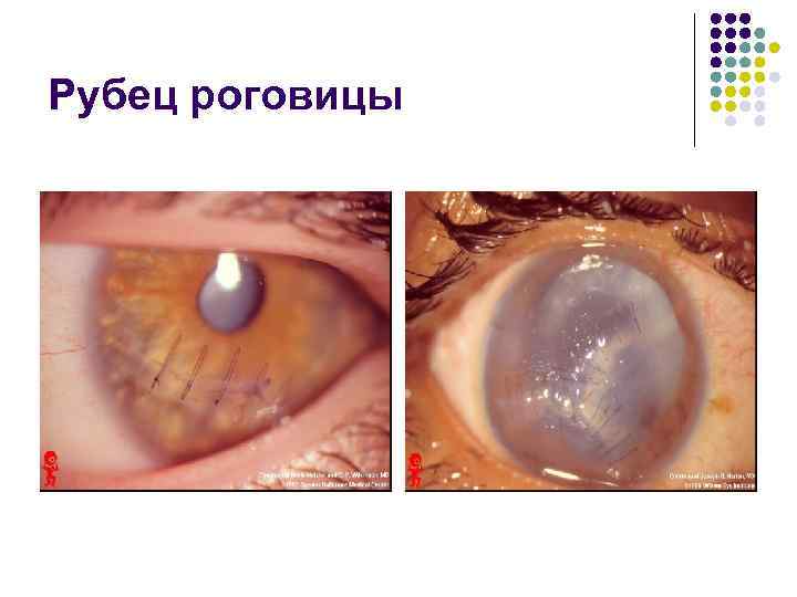 Рубец роговицы 