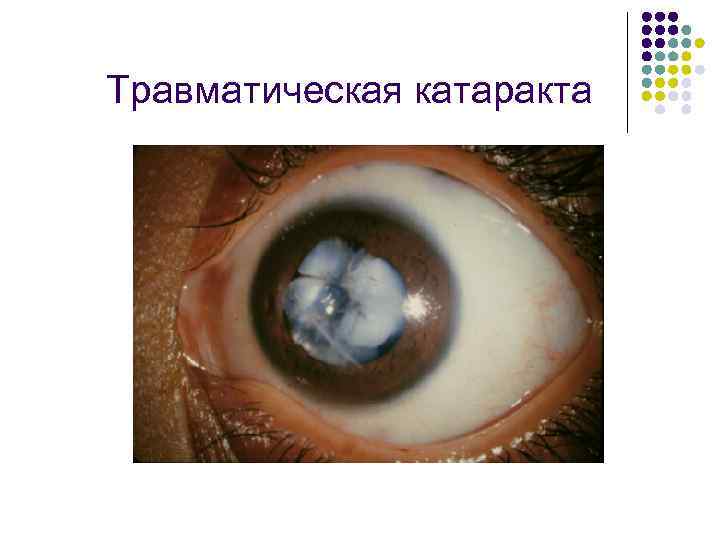 Травматическая катаракта 