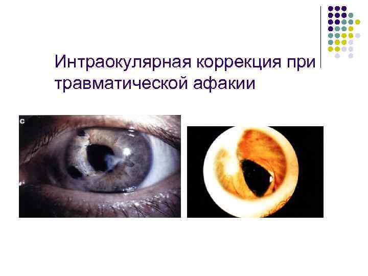 Интраокулярная коррекция при травматической афакии 