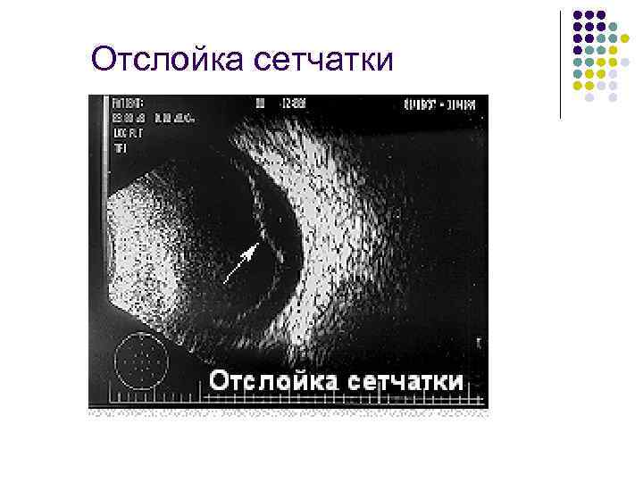 Отслойка сетчатки 