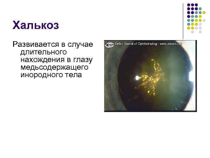 Халькоз Развивается в случае длительного нахождения в глазу медьсодержащего инородного тела 