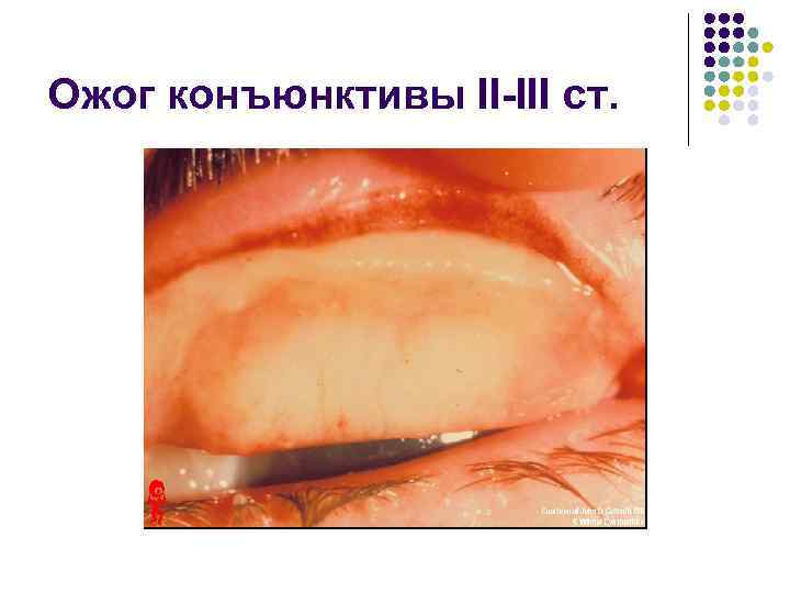 Ожог конъюнктивы II-III ст. 