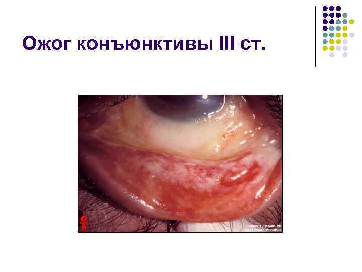 Ожог конъюнктивы III ст. 