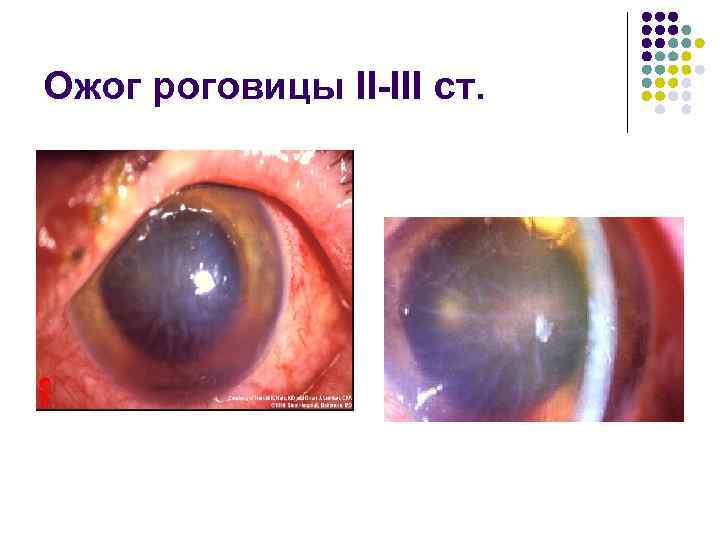 Ожог роговицы II-III ст. 