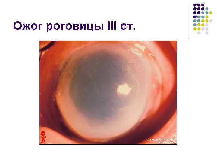 Ожог роговицы III ст. 
