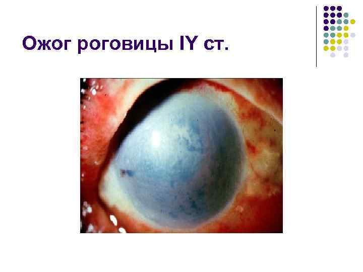 Ожог роговицы IY ст. 