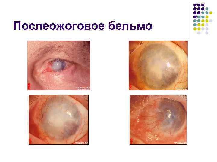 Послеожоговое бельмо 