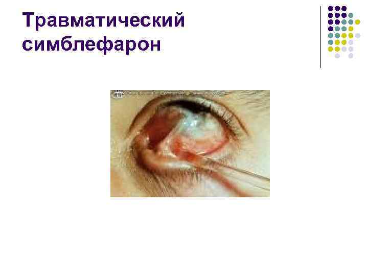 Травматический симблефарон 