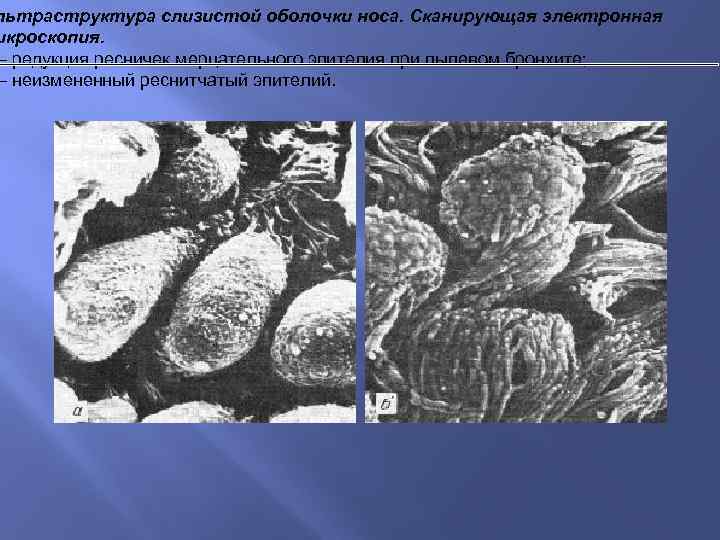 льтраструктура слизистой оболочки носа. Сканирующая электронная икроскопия. – редукция ресничек мерцательного эпителия при пылевом