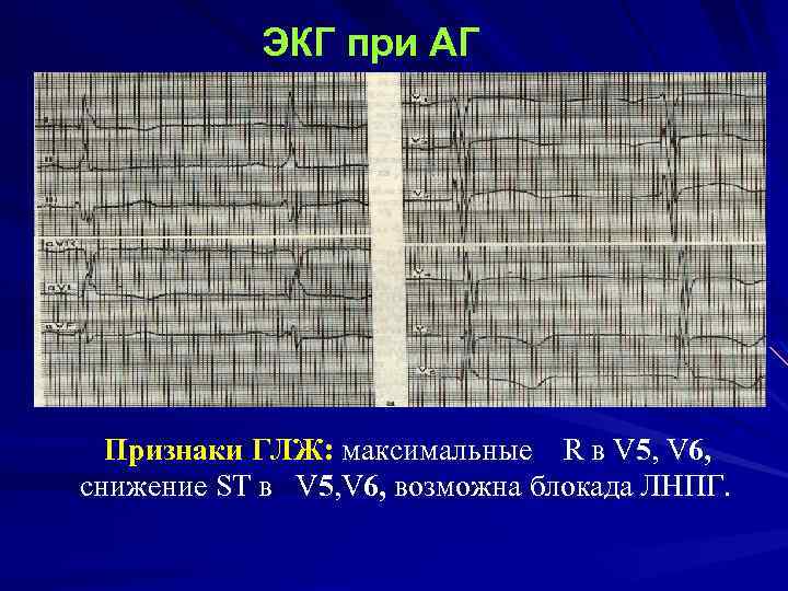 ЭКГ при АГ Признаки ГЛЖ: максимальные R в V 5, V 6, снижение ST