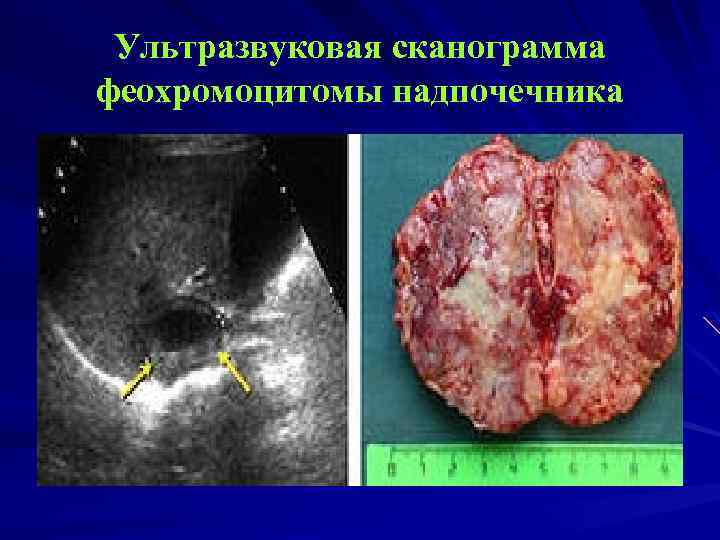 Ультразвуковая сканограмма феохромоцитомы надпочечника 