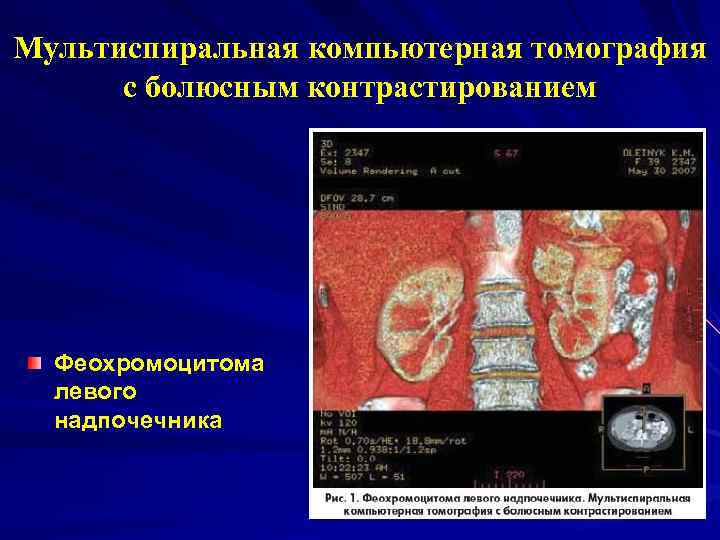 Мультиспиральная компьютерная томография с болюсным контрастированием Феохромоцитома левого надпочечника 