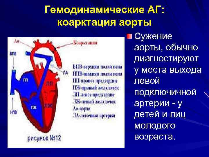 Стеноз аорты у детей презентация