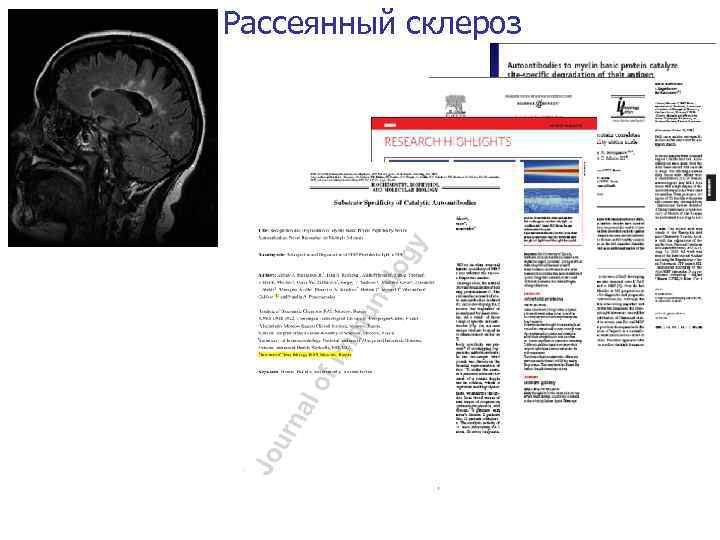 Рассеянный склероз 