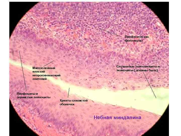 Лимфатические фолликулы Многослойный плоский неороговевающий эпителий Лимфоциты и зернистые лейкоциты Слущенные эпителиоциты и лейкоциты