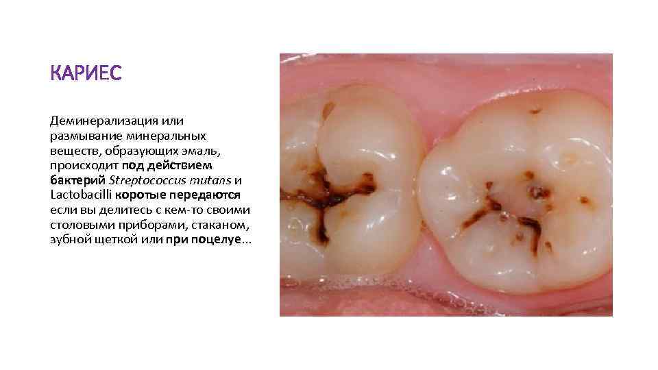 КАРИЕС Деминерализация или размывание минеральных веществ, образующих эмаль, происходит под действием бактерий Streptococcus mutans