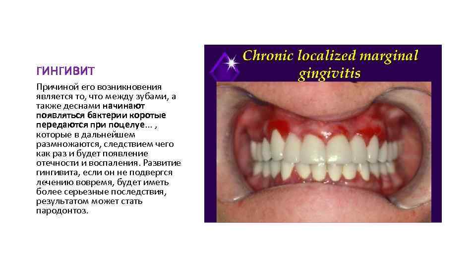 гингивит Причиной его возникновения является то, что между зубами, а также деснами начинают появляться