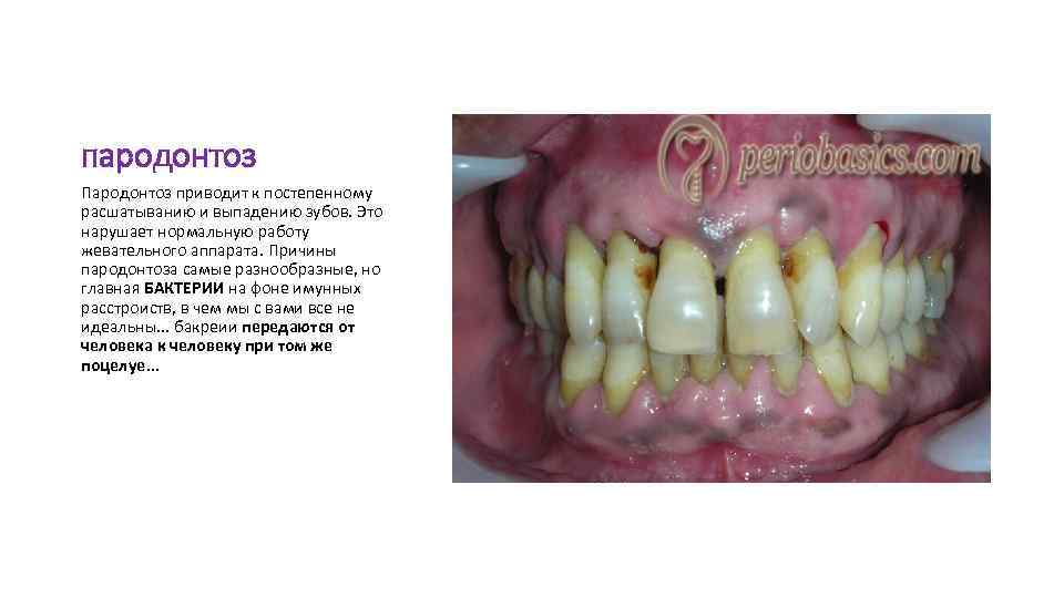 пародонтоз Пародонтоз приводит к постепенному расшатыванию и выпадению зубов. Это нарушает нормальную работу жевательного