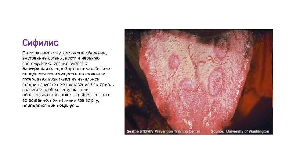 Сифилис Он поражает кожу, слизистые оболочки, внутренние органы, кости и нервную систему. Заболевание вызвано
