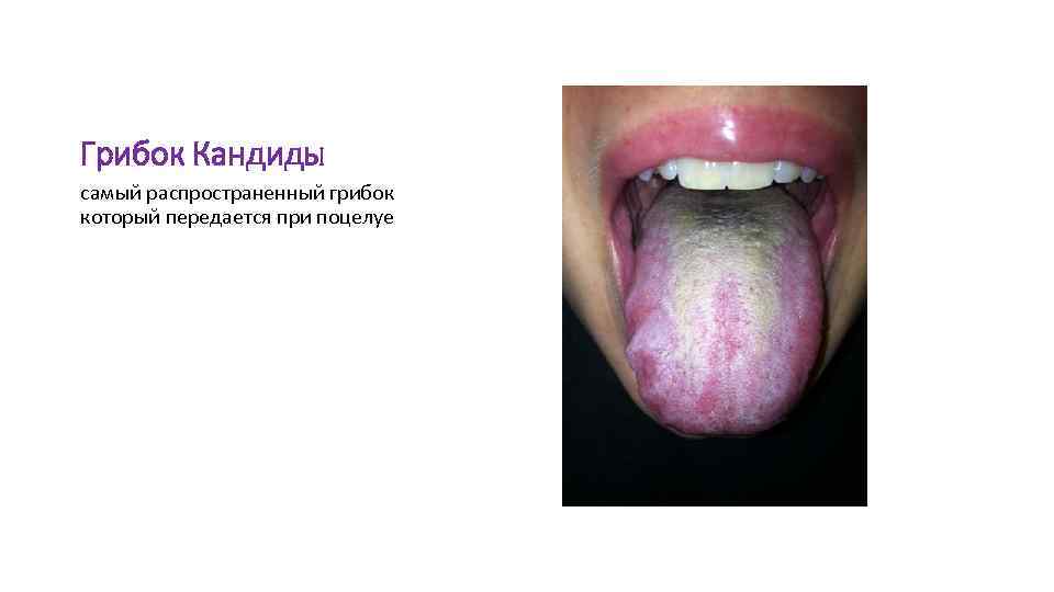 Грибок Кандиды самый распространенный грибок который передается при поцелуе 