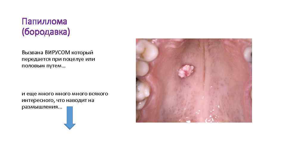 Папиллома (бородавка) Вызвана ВИРУСОМ который передается при поцелуе или половым путем… и еще много