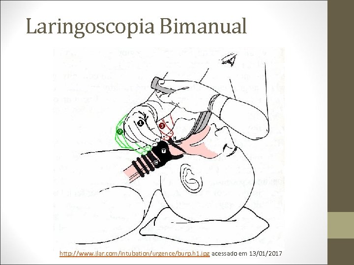 Laringoscopia Bimanual http: //www. jlar. com/intubation/urgence/burp. h 1. jpg acessado em 13/01/2017 