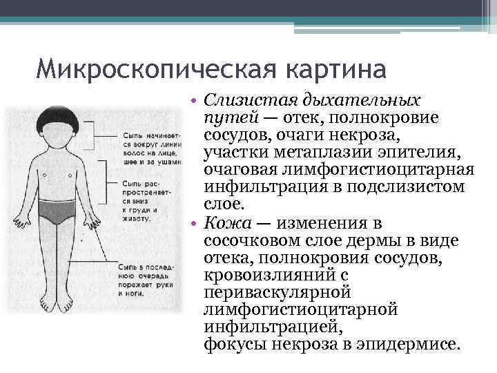 Микроскопическая картина • Слизистая дыхательных путей — отек, полнокровие сосудов, очаги некроза, участки метаплазии