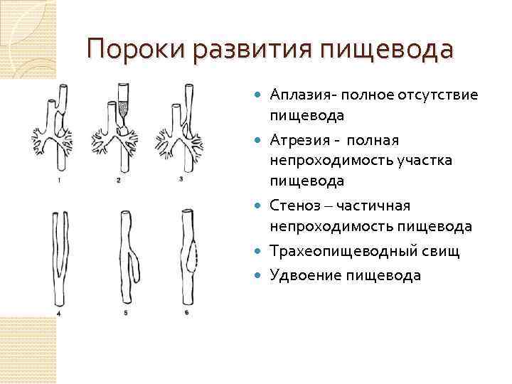 Пороки развития пищевода Аплазия- полное отсутствие пищевода Атрезия - полная непроходимость участка пищевода Стеноз