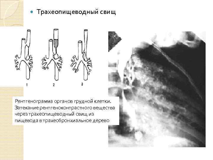  Трахеопищеводный свищ Рентгенограмма органов грудной клетки. Затекание рентгеноконтрастного вещества через трахеопищеводный свищ из